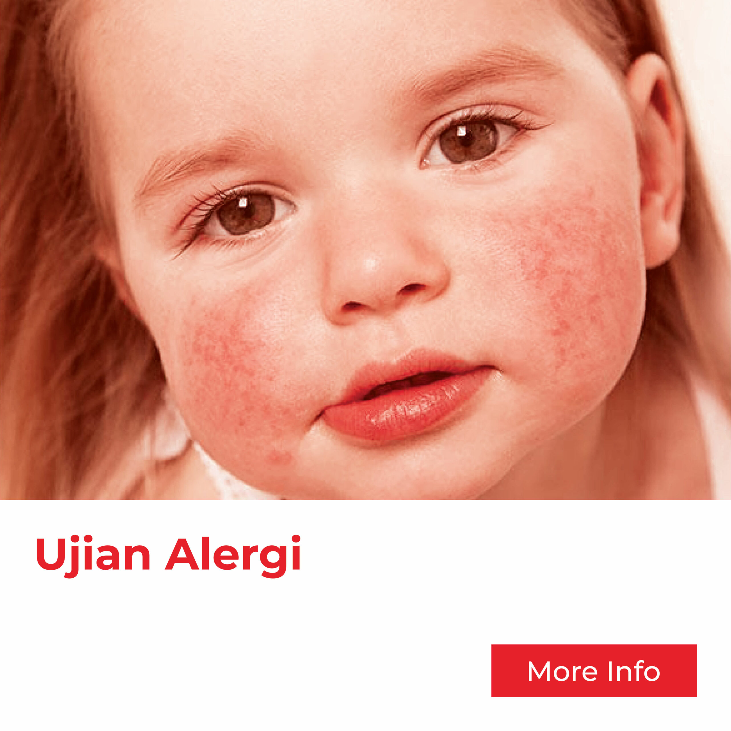 Ujian Alergi Kanak- Kanak & Bayi Dari Klinik As Salam